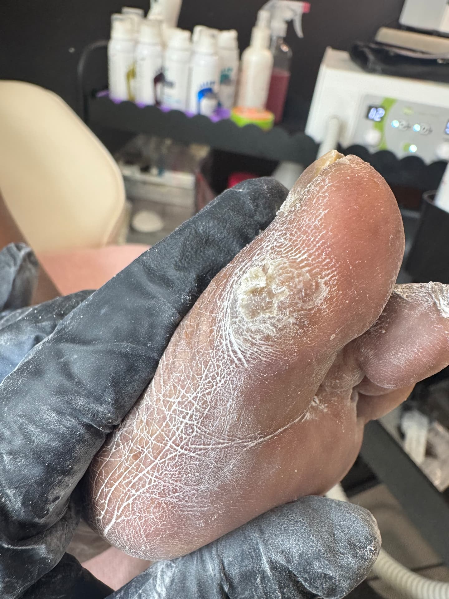 Callused forefoot before smoothing at Söle Aesthetics