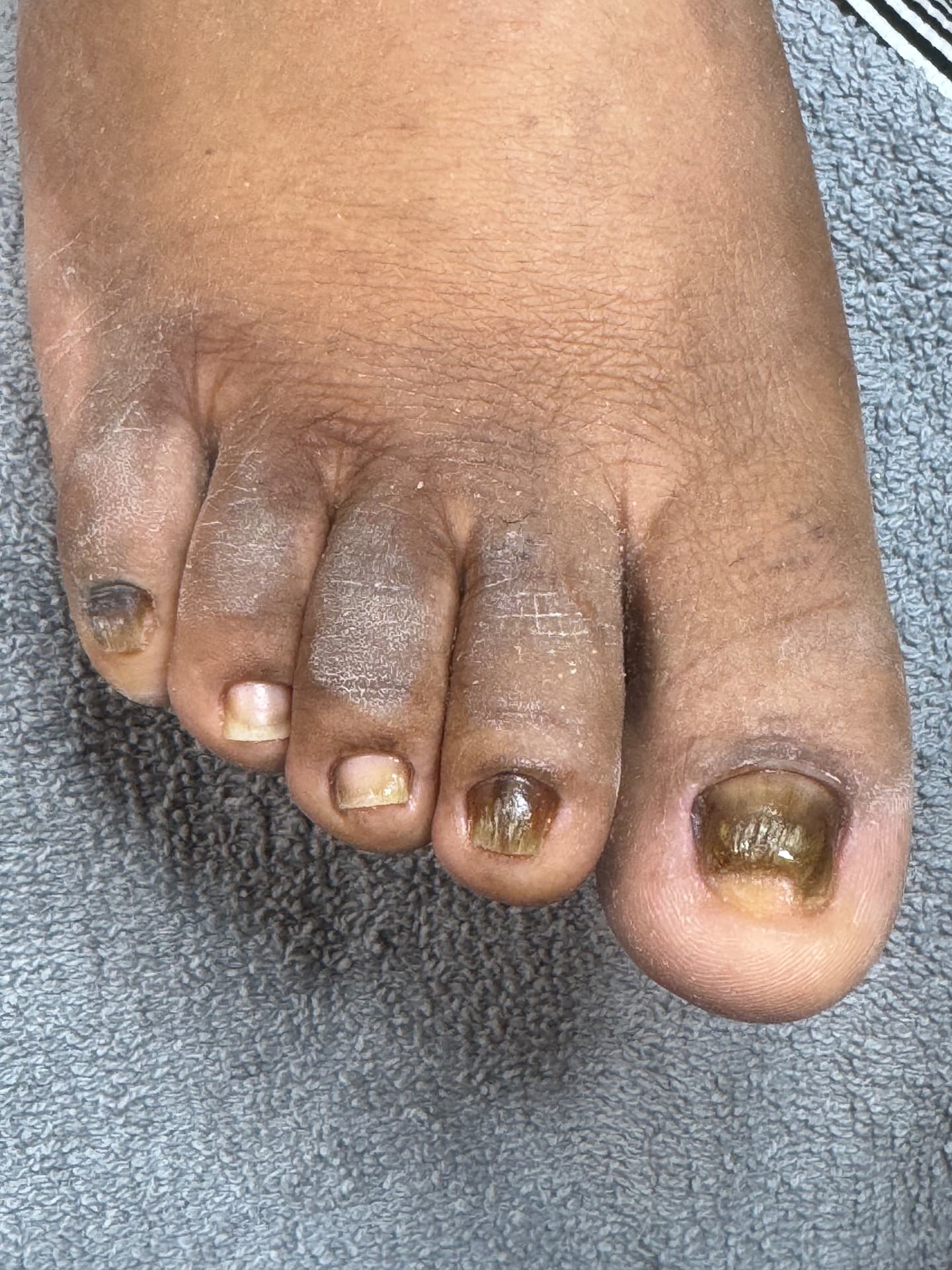 Fungal-Damaged Nail Restoration — before treatment at Söle Aesthetics