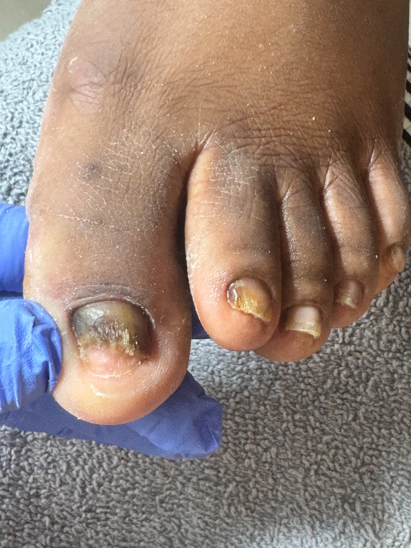 Thickened & Discolored Toenails — before treatment at Söle Aesthetics