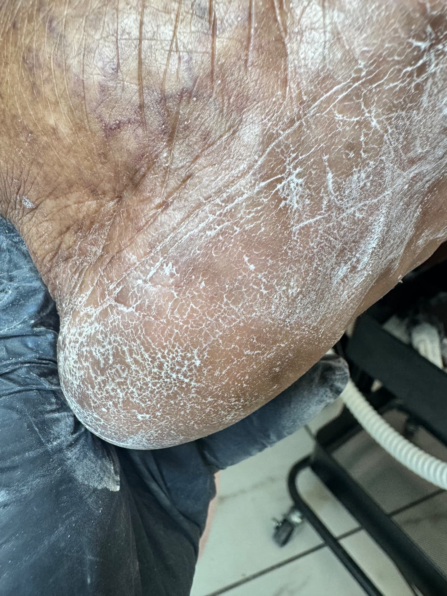 Severely dry, cracked heel before treatment at Söle Aesthetics