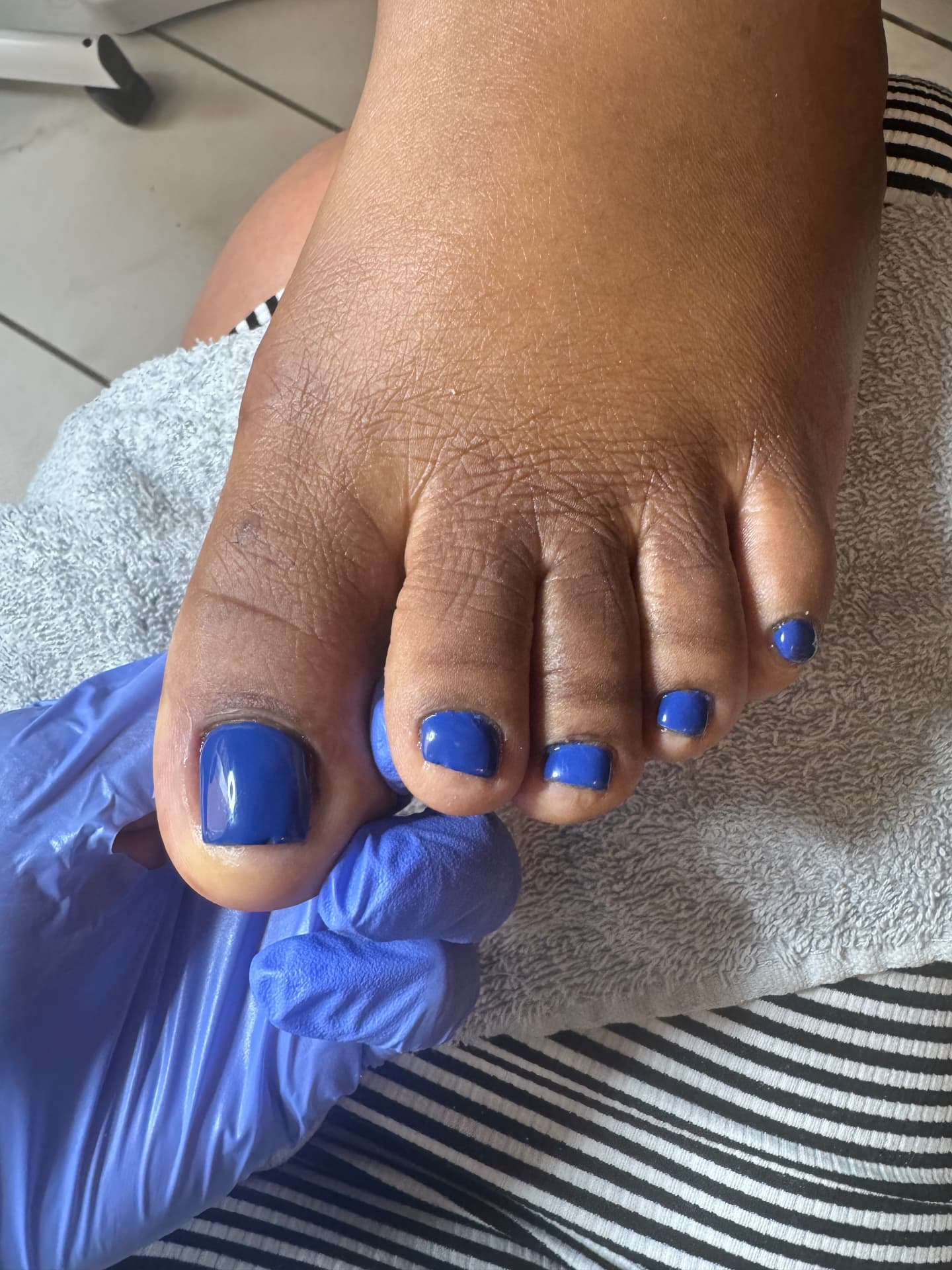 Thickened & Discolored Toenails — after treatment at Söle Aesthetics