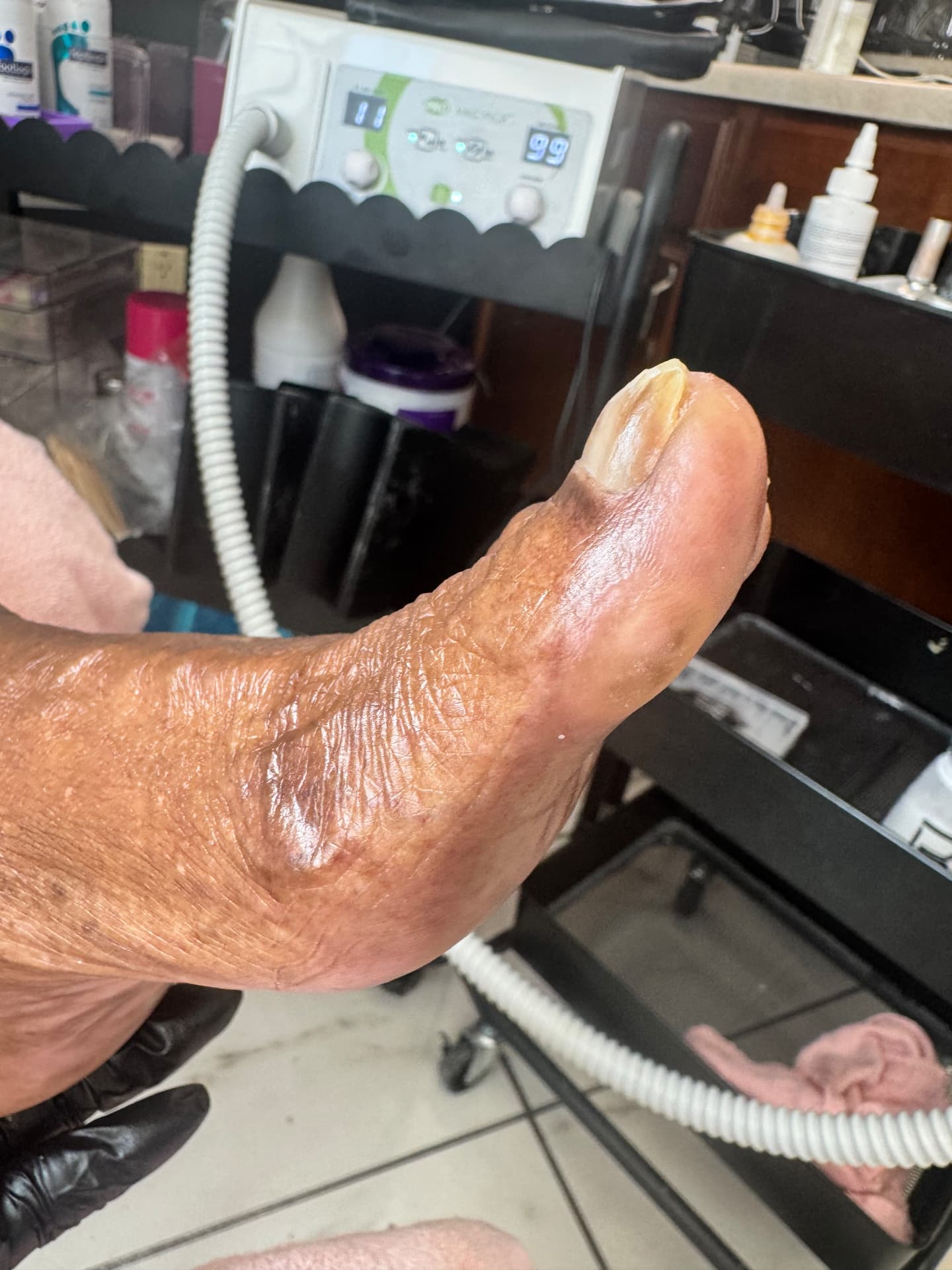 Thickened toenail and senior foot care at Söle Aesthetics