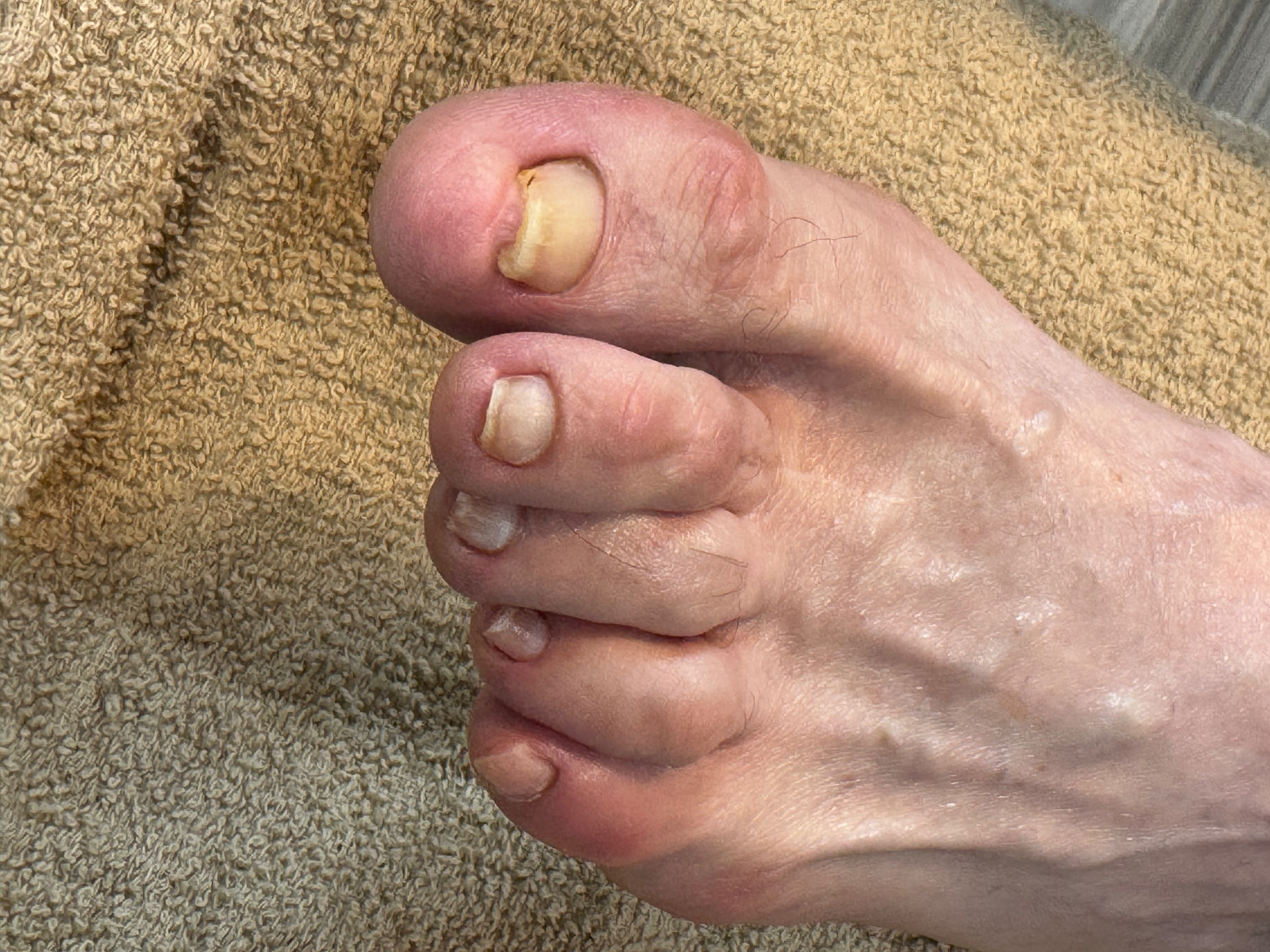 Men's pedicure with fungal toenail reduction at Söle Aesthetics