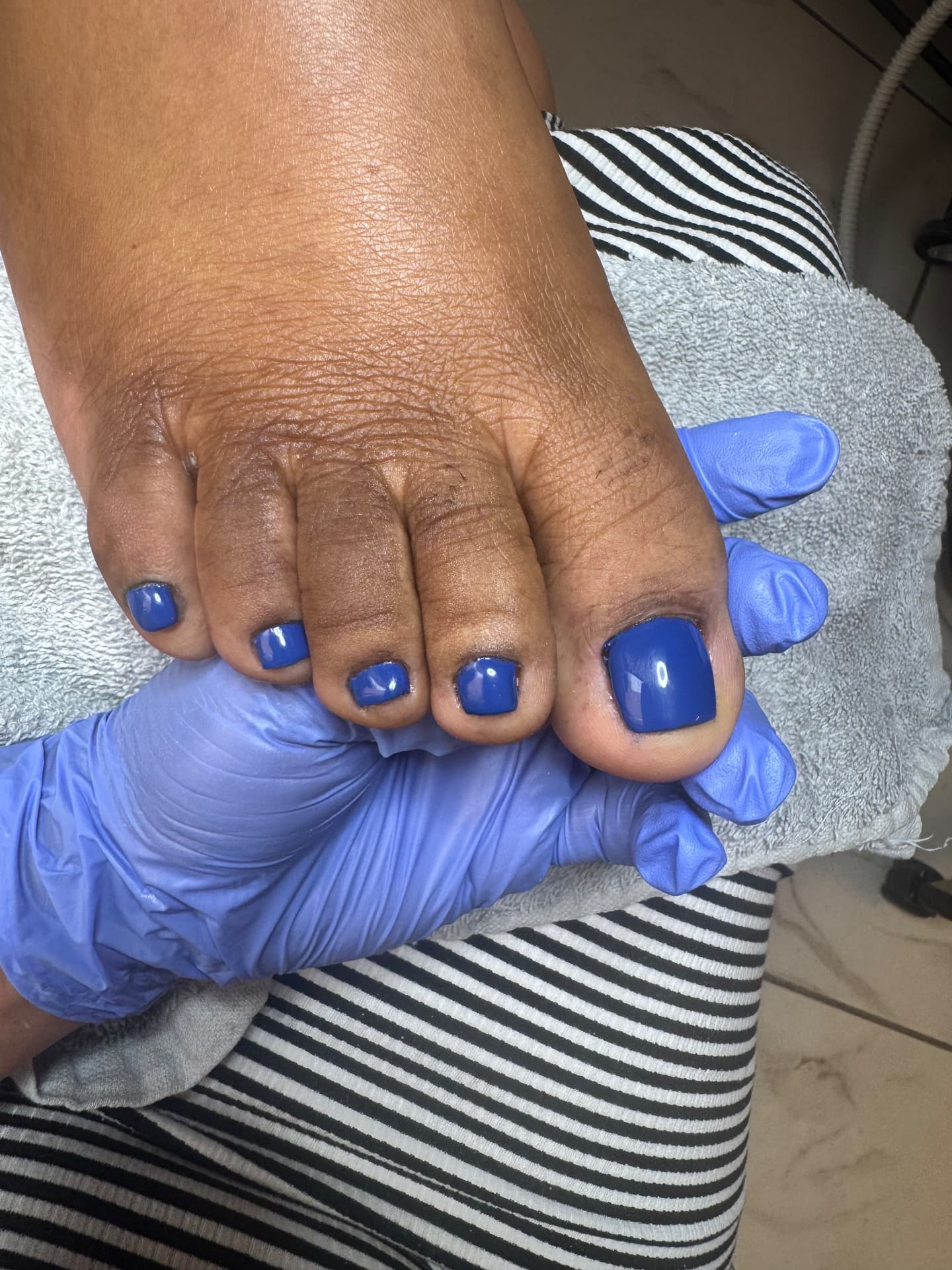 Fungal-Damaged Nail Restoration — after treatment at Söle Aesthetics