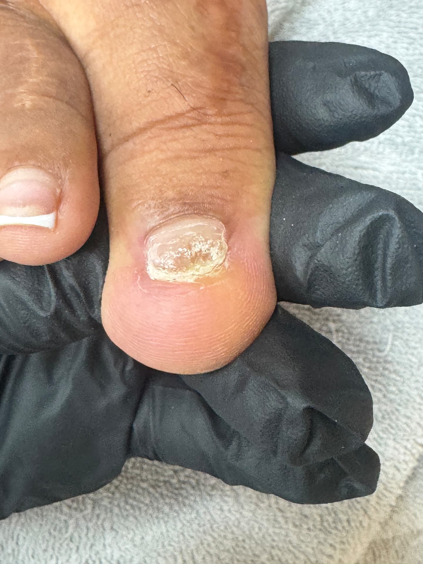 Inflamed, Overgrown Nail — before treatment at Söle Aesthetics