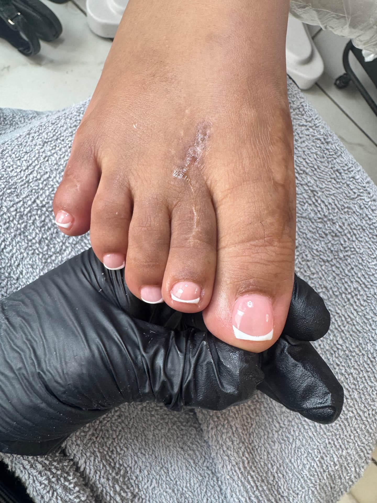 Inflamed, Overgrown Nail — after treatment at Söle Aesthetics